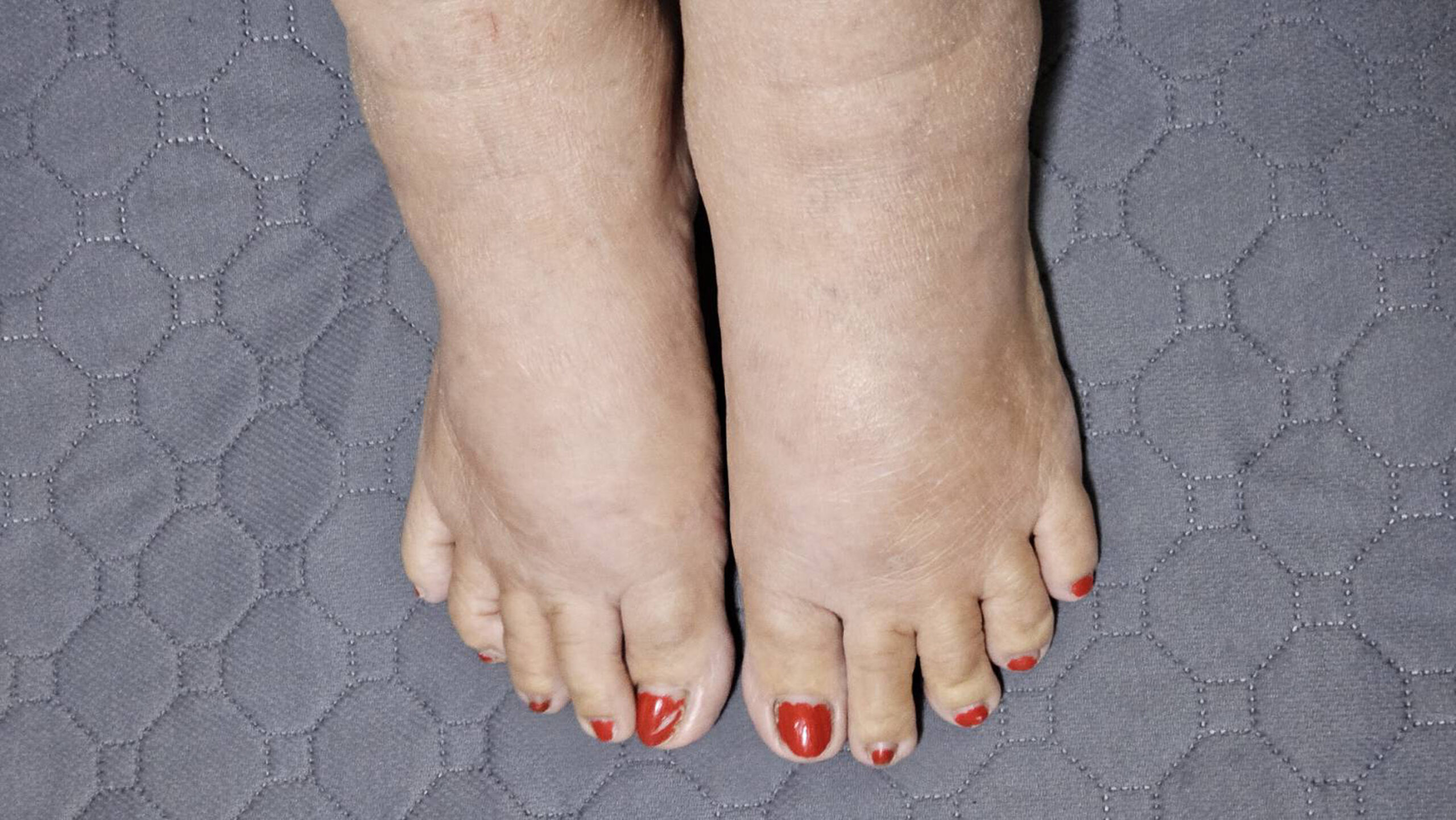 Swelling on feet during pregnancy